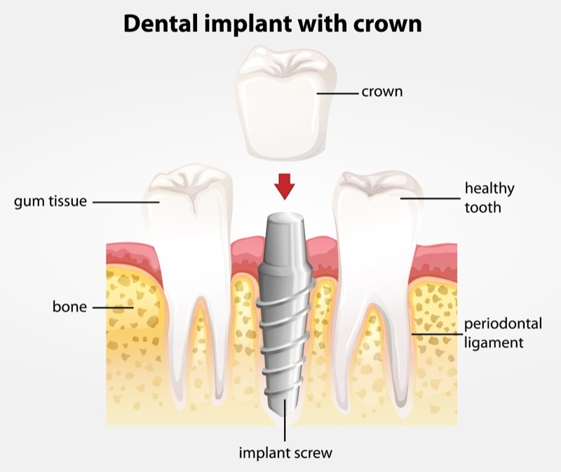 dental implant with crown.jpg